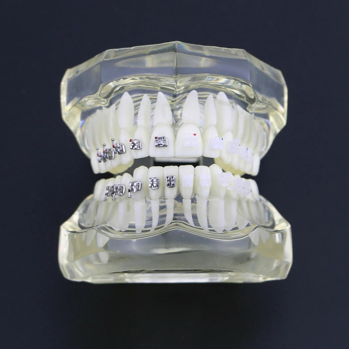 iDENTical Half Metal And Half Ceramic Brackets Orthodontics Model - M3003 (White)