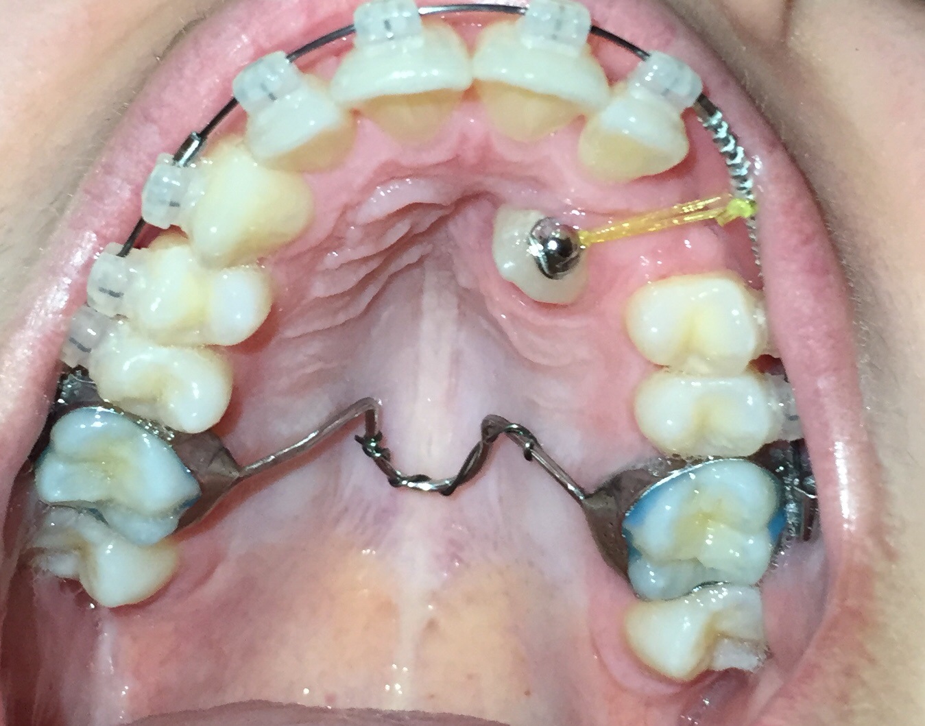 U Ortho Bondable Lingual Buttons Round (10/pk)