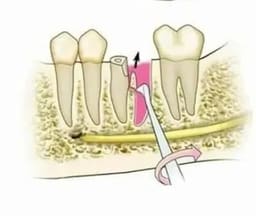 GDC Root Elevators Seldin Standard (E1r) - 3