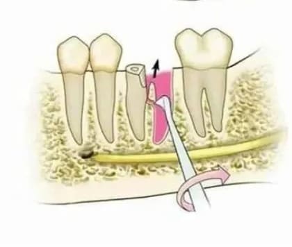 GDC Root Elevators Seldin Standard (E1r)