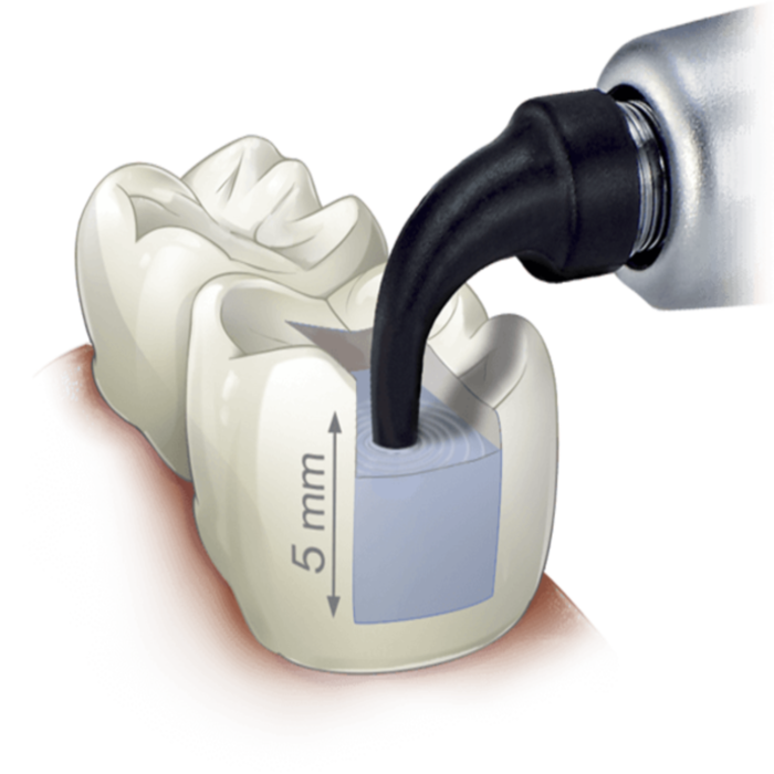 Kerr Sonic Fill - Sonic Activated, Bulk Fill Composite System