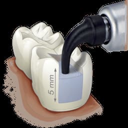 Kerr Sonic Fill - Sonic Activated, Bulk Fill Composite System - 8