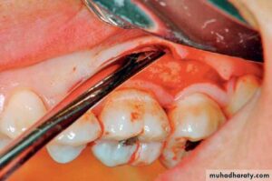 GI Dental Periosteal Elevator Molt (Large)