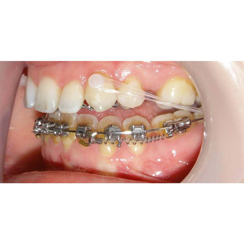 U Ortho Ceramic Lingual Buttons