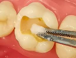 Ammdent D-Pulp (Devitalising Paste)