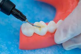 Kulzer Charisma Bulk Flow One Flowable Composite (66095520)