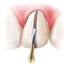 Prima Dental Predator Turbo Airotor Bur (For Crown Cutting)