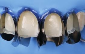 Polydentia Stainless Steel Matrix Strips - Soft