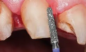 Frank Dental Flat End Taper FG Diamond Bur - Pack of 5