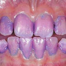 Vishal Dentocare Plak‐Check