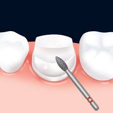 Frank Dental Flame Ogival FG Diamond Burs FO Series (Fine)
