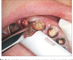 GII Root Elevators (Set of 10)