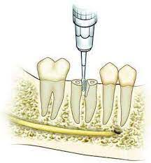 Marathon Straight Surgical Handpiece ES -100N