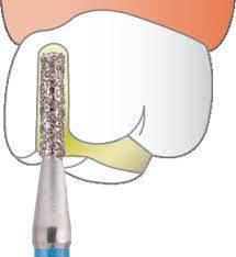 Frank Dental Cylinder Round Edge Diamond Burs SRS Series (Regular)