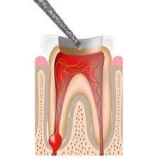 Prima Dental Endo Access Diamond Bur