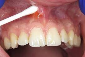 Septodont Progel-B Anaesthetic Gel (Jar of 30g)