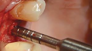 Oracraft Osteotomes - Concave Angulated