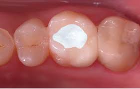 Septodont Cimpat Rose