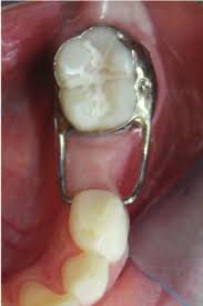 Kids-e-Dental Straight Loops (Pk of 10)