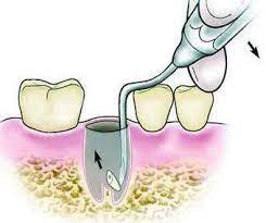 GDC Root Elevators Root Tip Pick Heidbrink - Left (Ehb2)