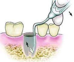 GDC Root Elevators Root Tip Pick Heidbrink - Left (Ehb2) - 4