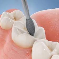 Frank Dental Football Shaped FG Diamond Burs EX -Series