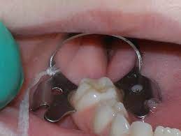 Gdc Rubber Dam Clamps Paedo