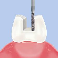 Frank Dental Cylinder Flat End Diamond Bur SF Series (Regular)