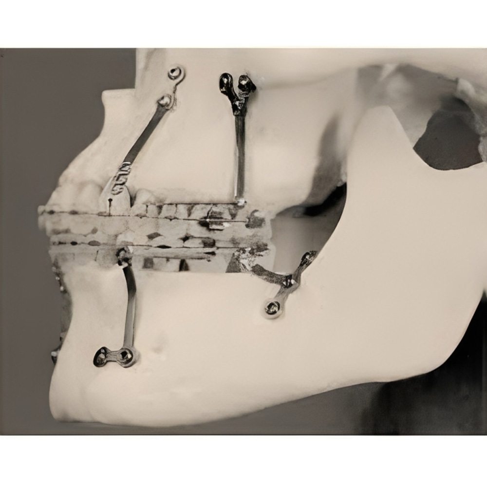 SK Surgicals Orthodontic Titanium Mini Anchorage Plate L Shape - 2mm
