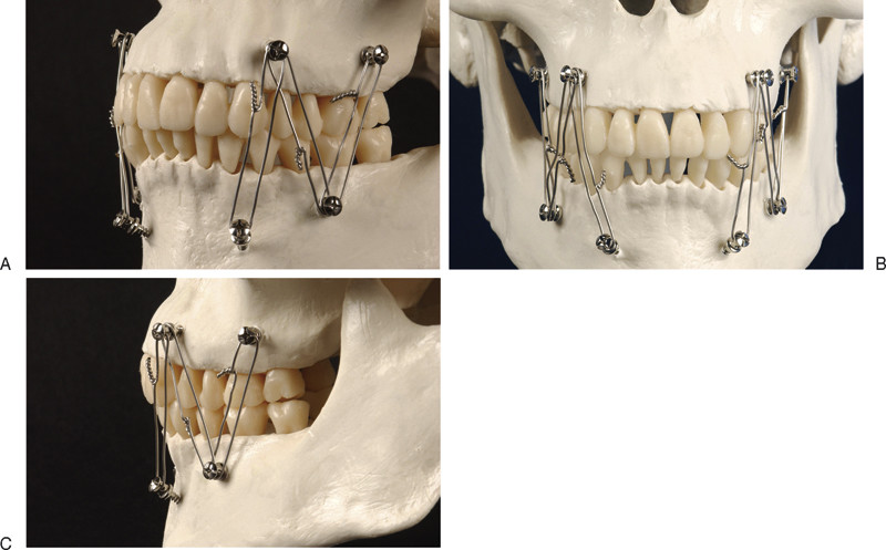 SK Surgicals SS Single Slot Screws - 2.5mm