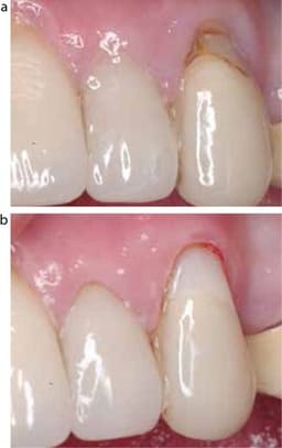 Vishal Dentocare Glass Core + Restorative GIC - 6