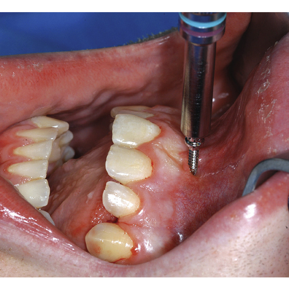 SK Surgicals SS IMF Screws