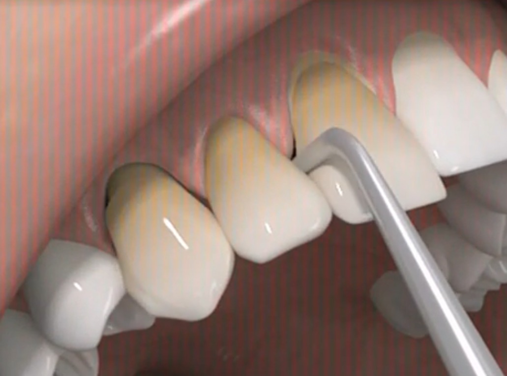 Waldent Automatic Crown Remover Instruments Kit (K21/5)