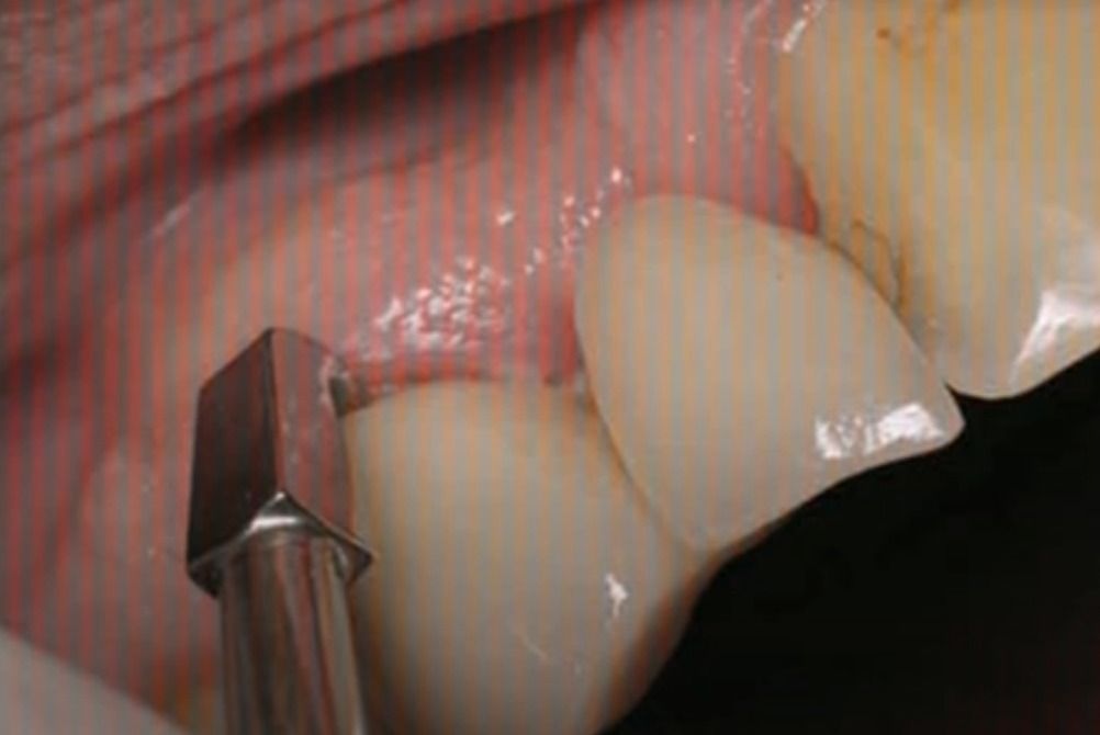 Waldent Crown Remover Tips