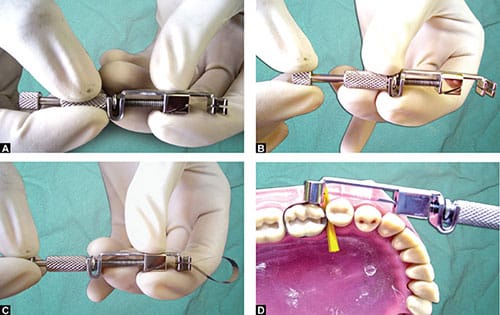 Waldent Tofflemire Retainer 8/105
