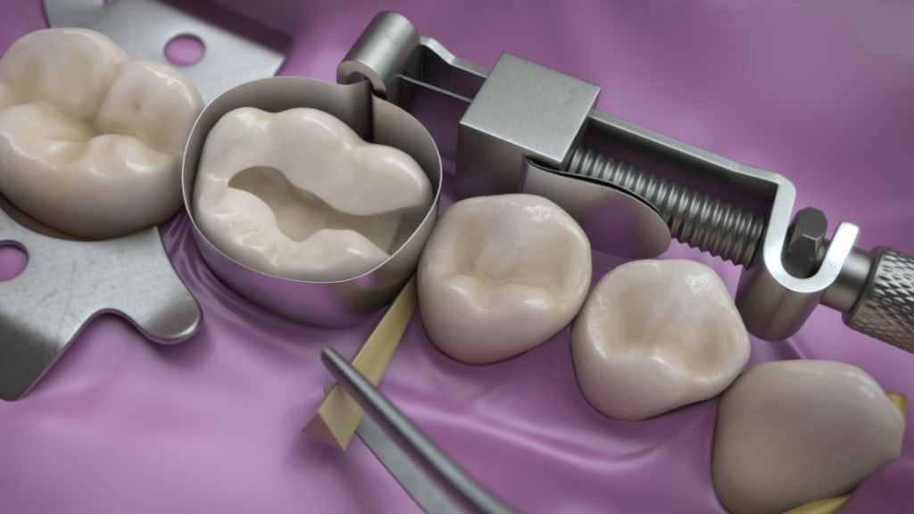 Waldent Tofflemire Retainer 8/105