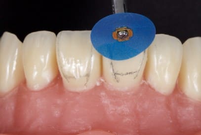 ET Dental Polishing Discs With Rivets Kit 