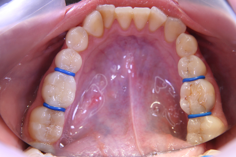 U Ortho Elastic Separators Pack of 1000