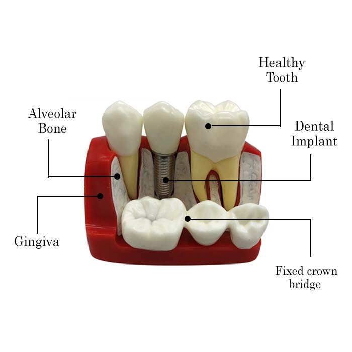 iDENTical Implant Analysis Model - M2017