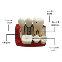 iDENTical Implant Analysis Model - M2017 - 7