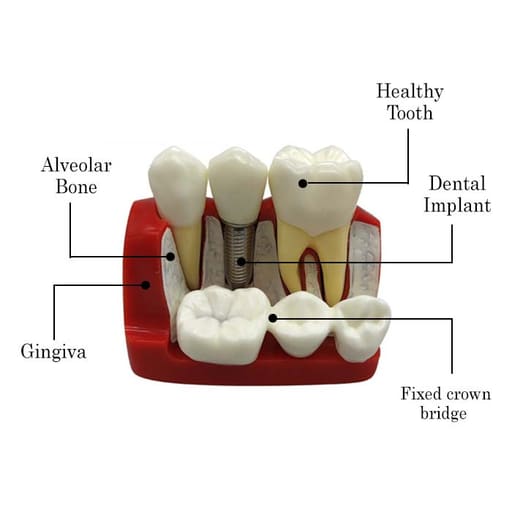 iDENTical Implant Analysis Model - M2017
