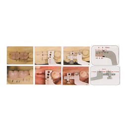Julldent Mesio Distal Implant Surgical Guide (Dr. Mathai Design) - 3