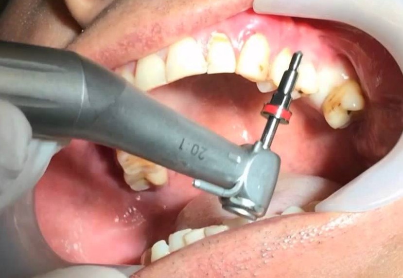 Waldent Dental Implant Handpiece 20:1 (W-772)