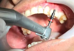 Waldent Dental Implant Handpiece 20:1 (W-772) - 30