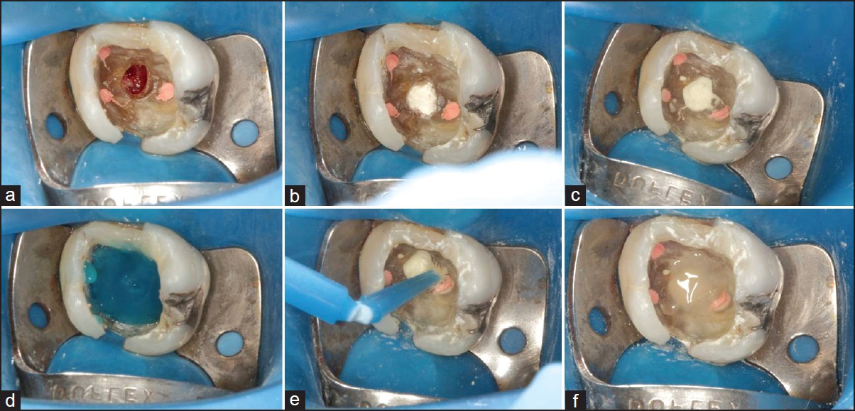 Vishal Dentocare Apiseal MTA