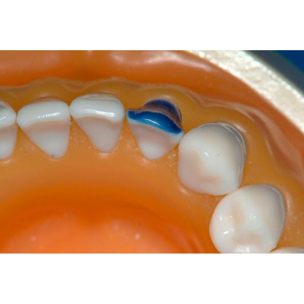 Maarc Inlay/Onlay Wax Sticks