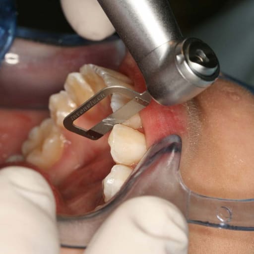 Waldent Orthodontic Inter-Proximal Reduction (IPR) Kit  