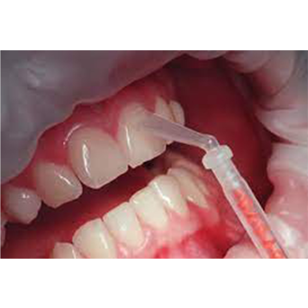 Medmix Mixpac Intra Oral Brush