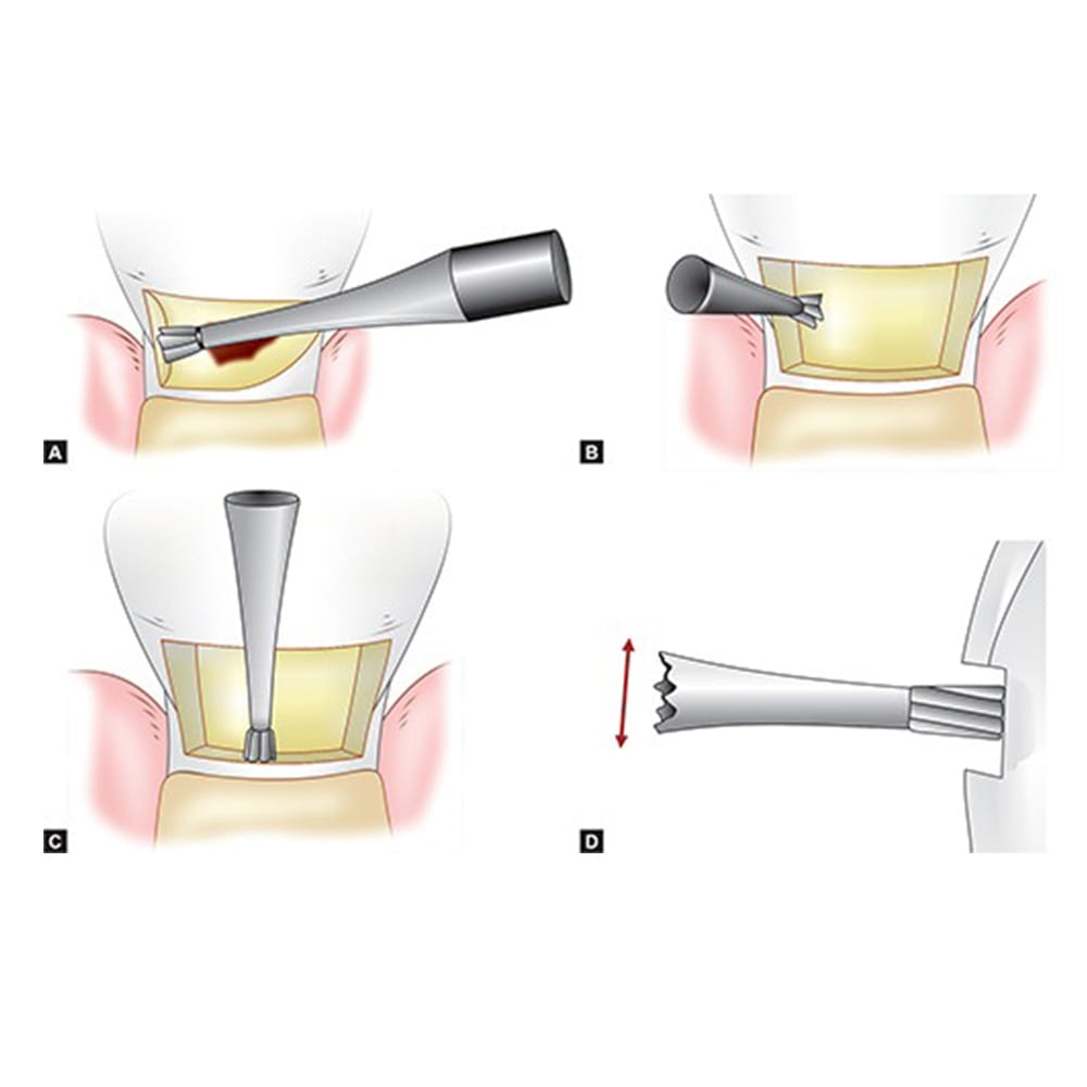 Frank Dental Carbide Bur C.2.023.HP -Pk/1 (Made in Germany)