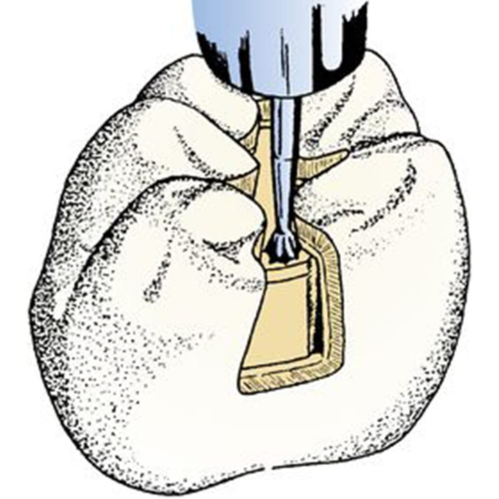 Frank Dental Carbide Bur C.2.023.HP -Pk/1 (Made in Germany)